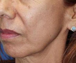 Secret RF Before & After Patient #1617